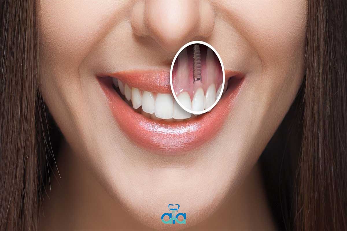  ایمپلنت پراما برترین ایمپلنت دندانی ست که به خاطر ویژگی های منحصر به فرد خود، همچون انقلابی در حوزه ی دندانپزشکی دیجیتال است.