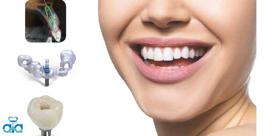 ایمپلنت از روش های پر طرفدار در دندانپزشکی ست که برای کسانی که دندان خود را به هر دلیلی از دست داده اند، استفاده میشود-ایمپلنت پراما/شرکت آراز طب آسیا