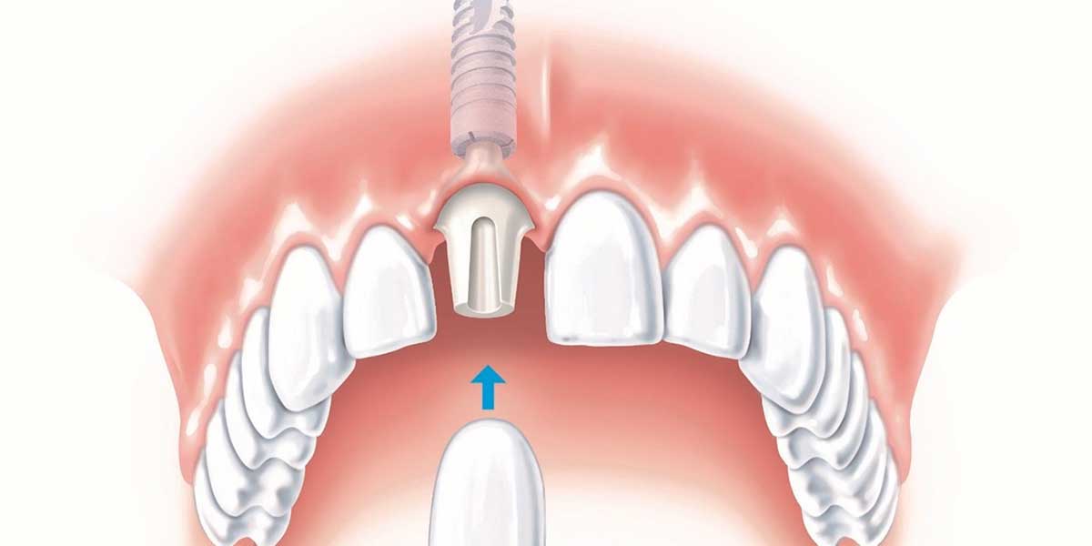 جراحی ایمپلنت دندان