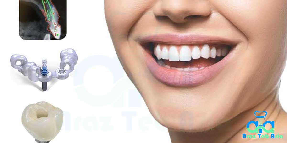 ایمپلنت دندانی 