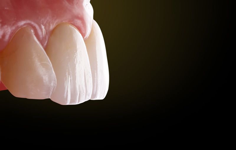 ایمپلنت دندانی بهترین جایگزین دندان
