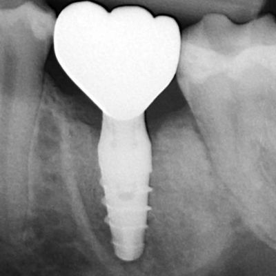 عکس انطباق دندان با ریشه ایمپلنت دندانی پراما