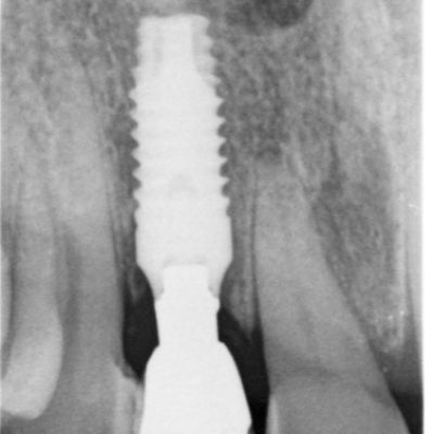 عکس انطباق پایه ایمپلنت دندانی پراما با  بهترین شکل لثه در جراحی ایمپلنت