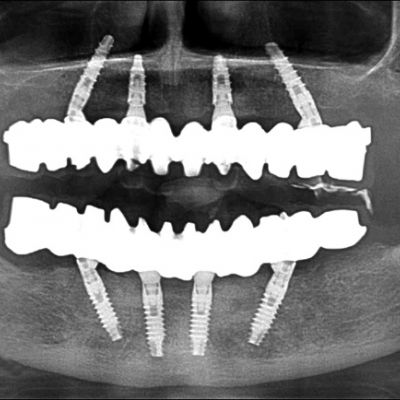 قرار گیری ایمپلنت دندانی پراما در دهان در  نمونه جراحی ایمپلنت
