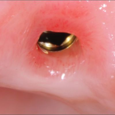 ایجاد حفره و تطابق ایمپلنت دندانی پراما با لثه
