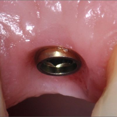 پایه و ریشه ایمپلنت دندانی پراما