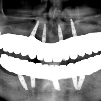  اسکن عمل جراحی ایمپلنت و نقش ایمپلنت دندانی پراما