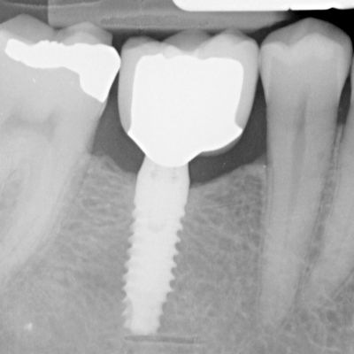  بررسی عمل جراحی ایمپلنت و نقش ایمپلنت دندانی پراما