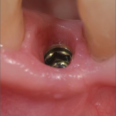  جایگزینی ایمپلنت دندانی عمل جراحی ایمپلنت و نقش ایمپلنت دندانی پراما