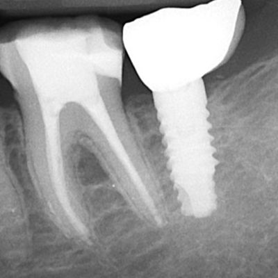  عکس پایه ایمپلنت دندانی  پراما در لثه عمل جراحی ایمپلنت و نقش ایمپلنت دندانی پراما