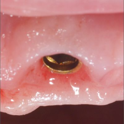  قرارگیری پایه ایمپلنت دندانی پراما در لثه در جراحی ایمپلنت